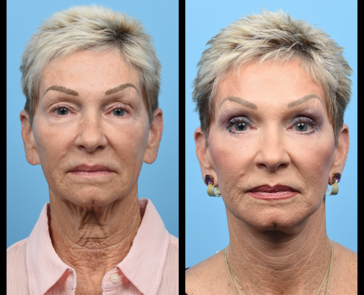 Before and After | Facial Focus Cosmetic Surgery | Austin